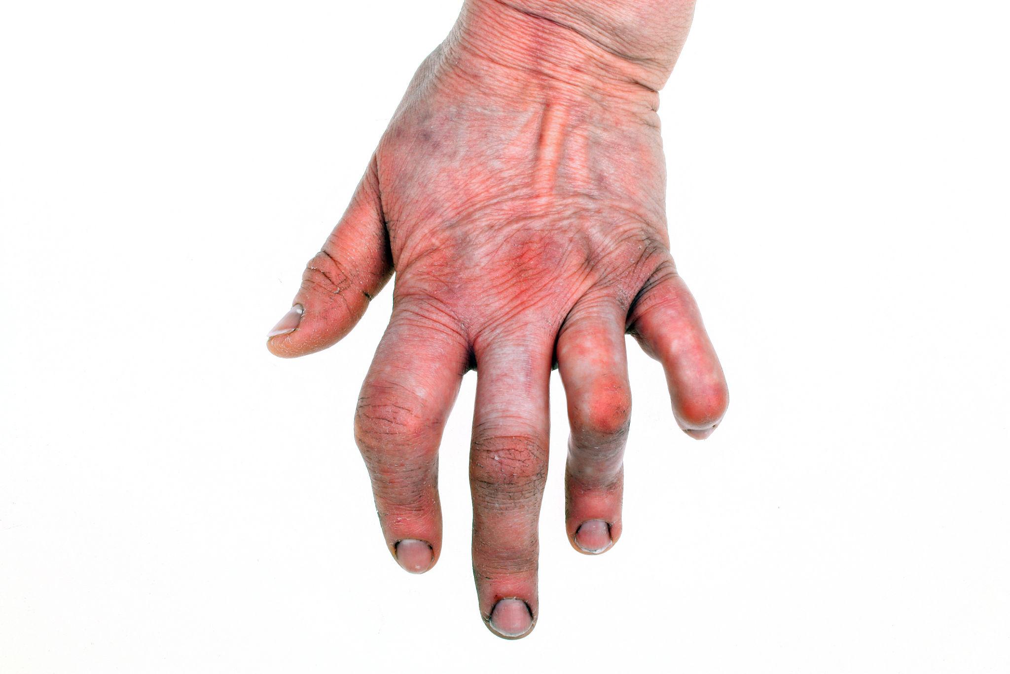 Rheumatoid